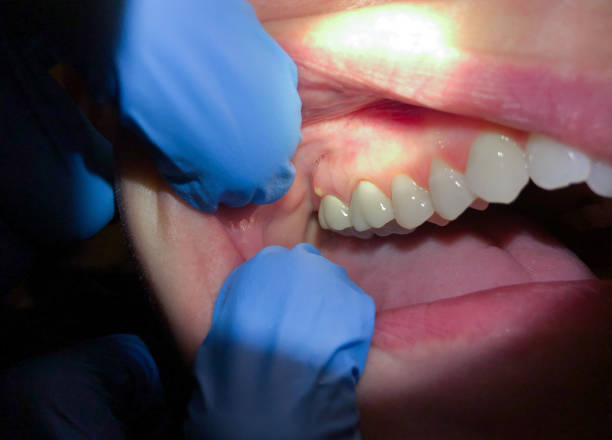 Best Emergency Dental Care for Abscessed Tooth in St James, MO