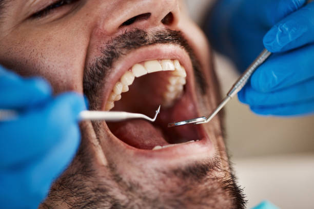 Best Emergency Dentist for Knocked-Out Tooth in St James, MO