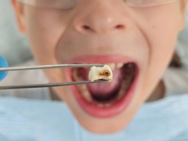 Best Broken or Cracked Tooth Emergency Dentist in St James, MO